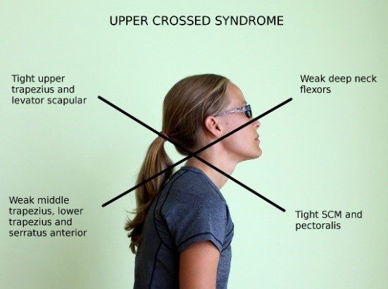 Upper Crossed Syndrome diagram