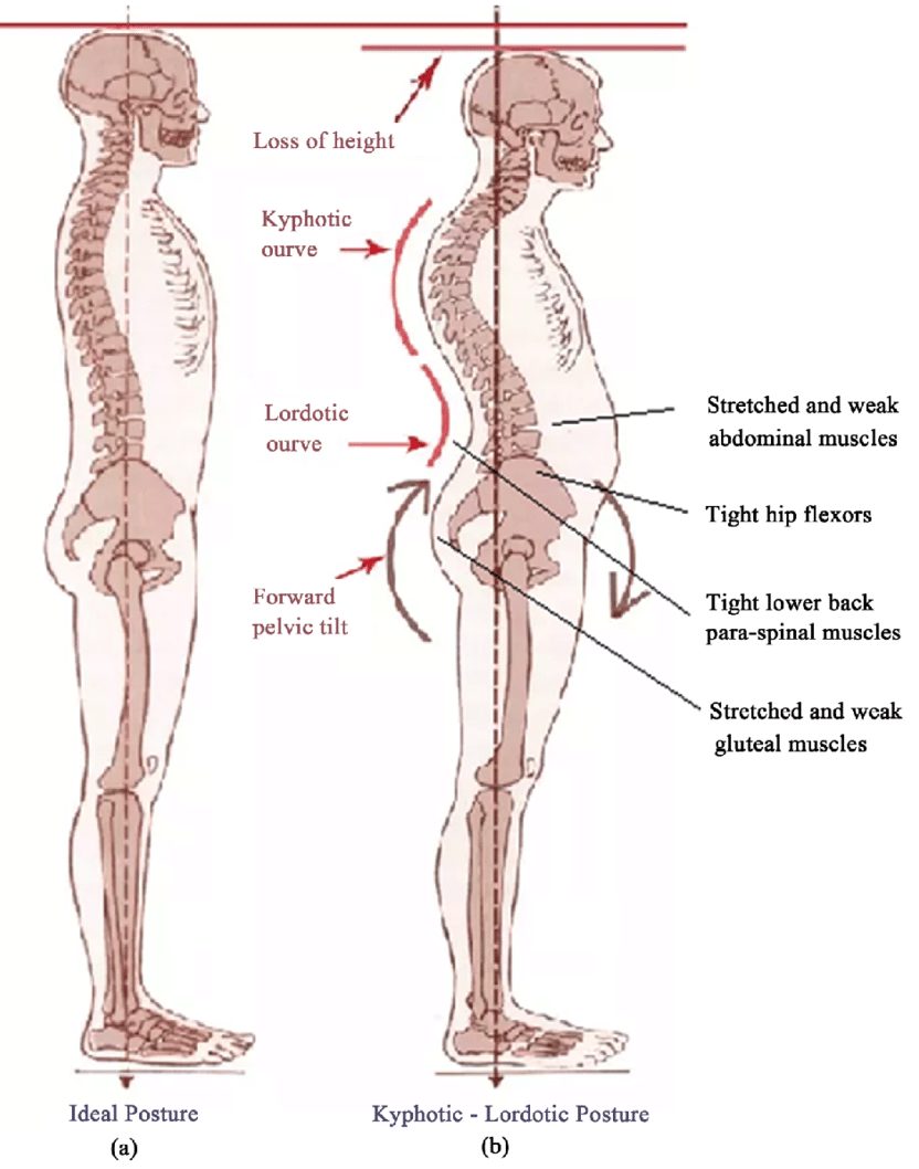 Kyphotic-lordotic posture diagram